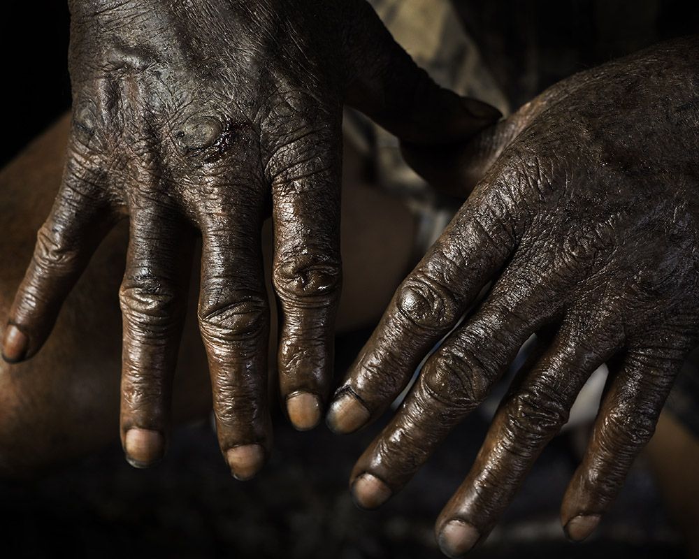 Open sores and peeling skin are common among workers who handle tanning chemicals without gloves. Some say their hands become so stiff that they cannot open their fingers unless their skin is wet. Image by Larry C. Price. Bangladesh, 2016.