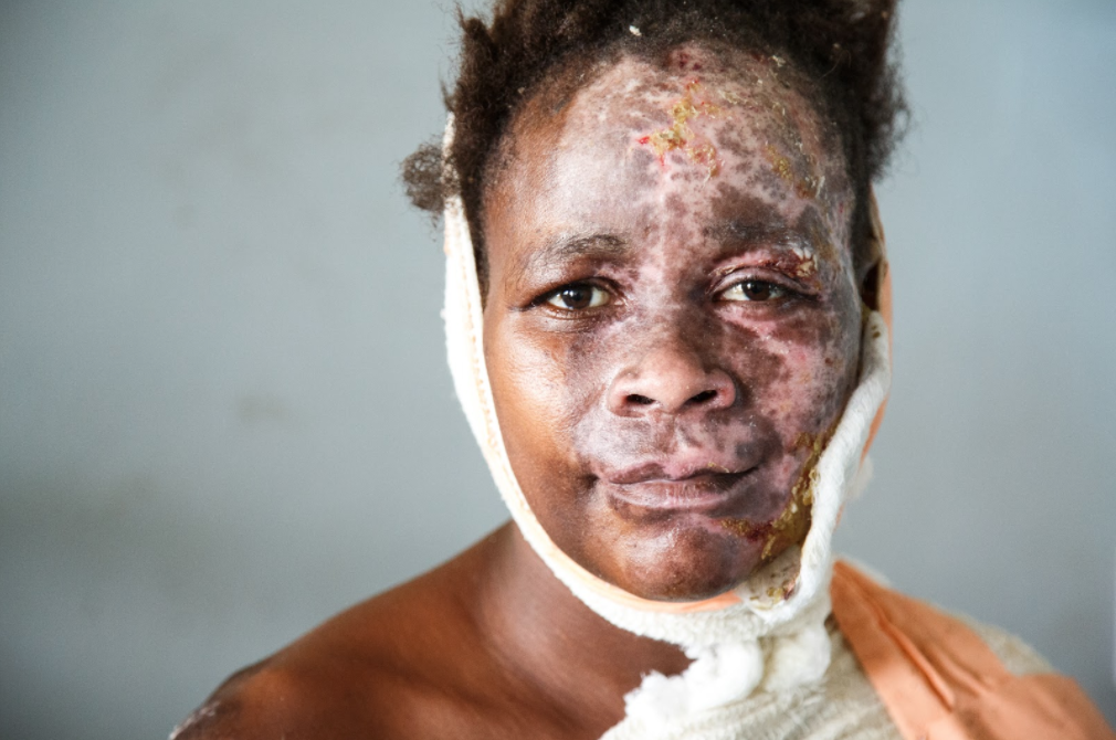 Mary burned her hair and face when she fell into the flames of an open fire on which she was heating water for tea. Mary has epilepsy and the accident happened whilst she was having a fit. She remembers nothing but the pain. Now she is being treated at Kamuzu Central Hospital's burns unit in Lilongwe - she is slowly on the mend. Image by Nathalie Bertrams. Malawi, 2017.