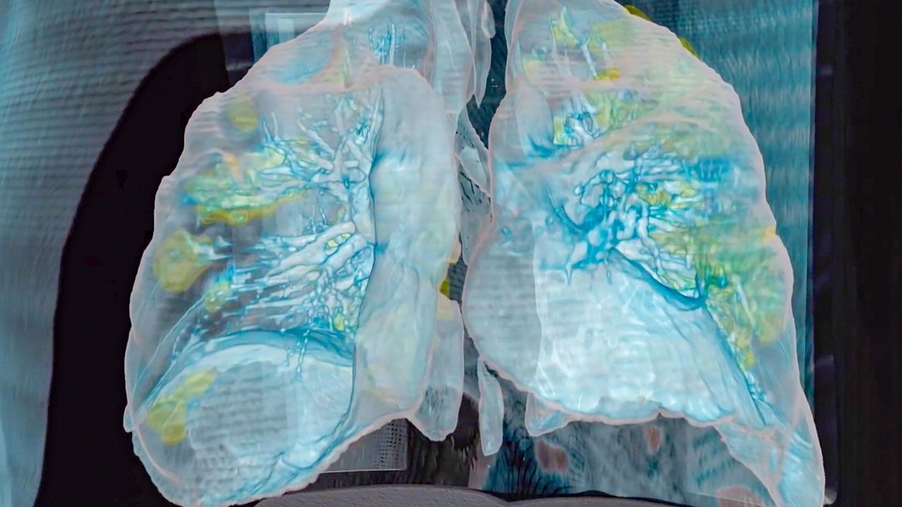 The coronavirus wreaked extensive damage (yellow) on the lungs of a 59-year-old man who died at George Washington University Hospital, as seen in a 3D model based on computerized tomography scans. Image courtesy George Washington Hospital and Surgical Theater. United States, 2020.
