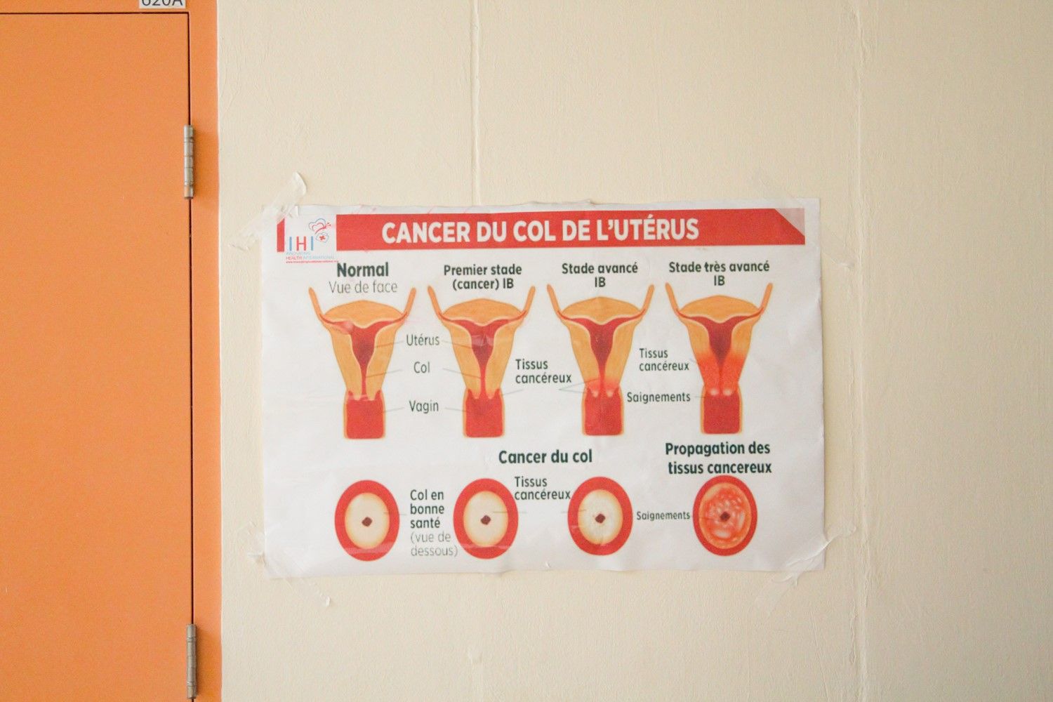 The screening program is held once a month at La Providence. In addition to the screenings, a health educator informs the women about the signs and symptoms of breast and cervical cancer. Some women hear about the program through community health workers, others from their doctors. Women who have been previously screened and tested positive also come to receive cryotherapy treatment. Like many women at the clinic, Lemour came today because the screening was free and she knew if she tested positive, she could get the treatment the same day. Image by Anna Russell. Haiti, 2017.