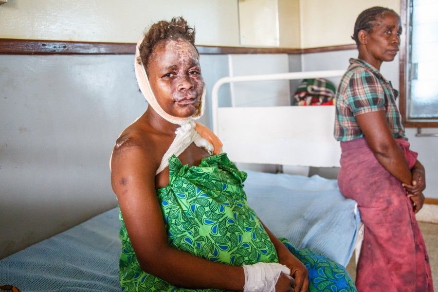 Mary, who suffers from epilepsy, fell into an open fire when she had a fit. The Kamuzu Central Hospital in Lilongwe, where she is currently undergoing treatment, has one of the few functioning burn’s units in the country. Image by Nathalie Bertrams. Malawi, 2017.