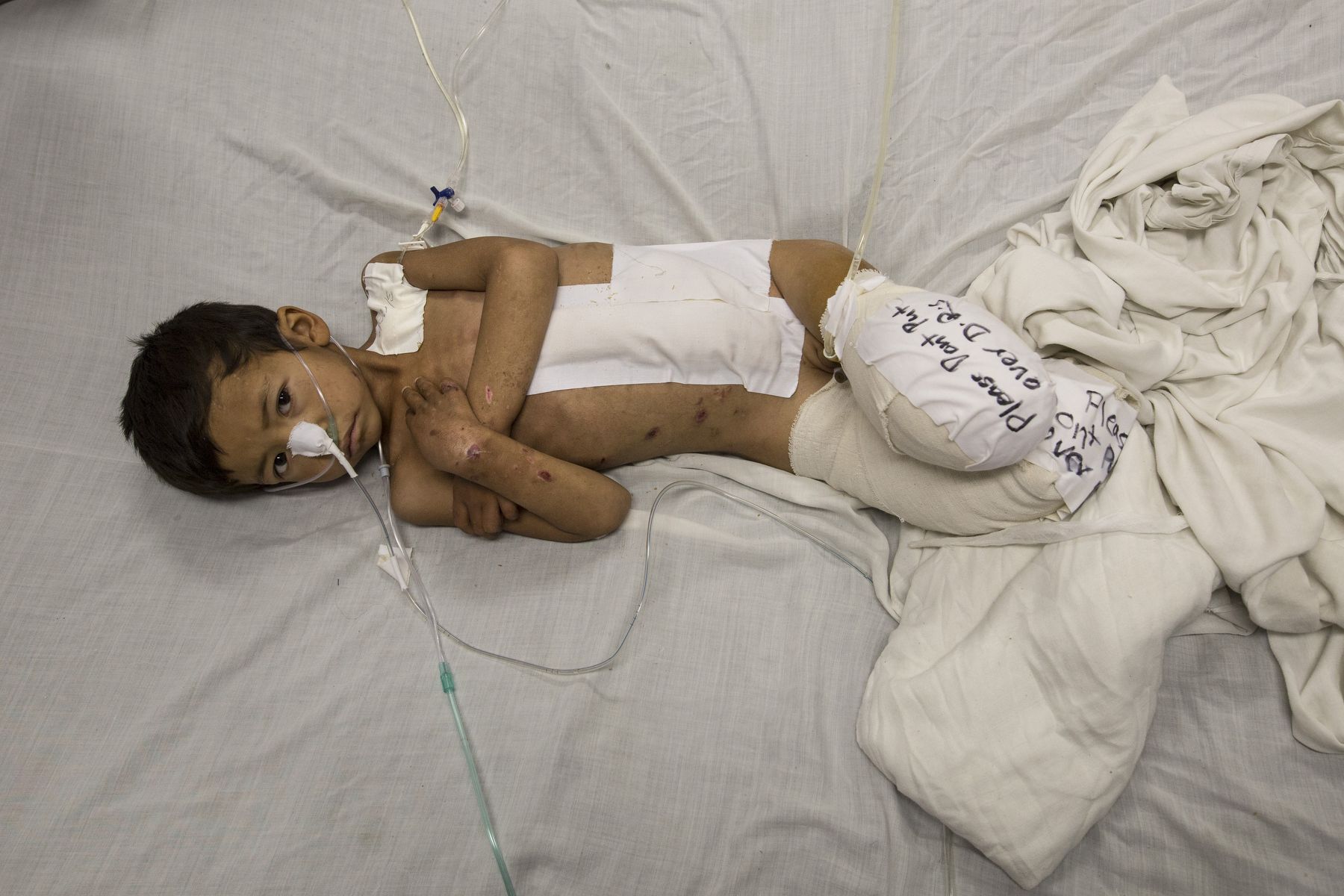 Kabir, 5, from Faryab lays in bed at the Emergency hospital in Kabul on April 3, 2016. He is a victim of a rocket attack, lost both of his legs along with his sister and brother who were also killed. Image by Paula Brontstein. Afghanistan, 2016.