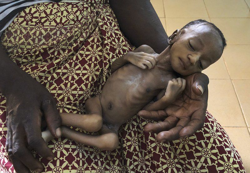 One-month old Haboue Solange Boue, awaiting medical care for severe malnutrition, is held by her mother, Danssanin Lanizou, 30, at the feeding center of the main hospital in the town of Hounde, Tuy Province, in southwestern Burkina Faso on Thursday, June 11, 2020. With the markets closed because of coronavirus restrictions, her family sold fewer vegetables. Lanizou is too malnourished to nurse her. Image by Sam Mednick/AP Photo. Burkina Faso, 2020.