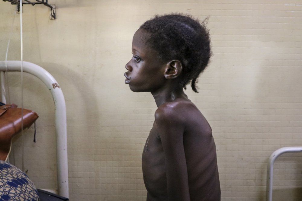 Nafissetou Niampa, 14, who struggles to breathe due to a heart condition, is treated for malnutrition at Yalgado Ouedraogo University in Ouagadougou, Burkina Faso on Monday, June 22, 2020. Coronavirus-related movement restrictions limited her family's ability to make money to pay for medicine and buy food. Image by Sam Mednick/AP Photo. Burkina Faso, 2020.
