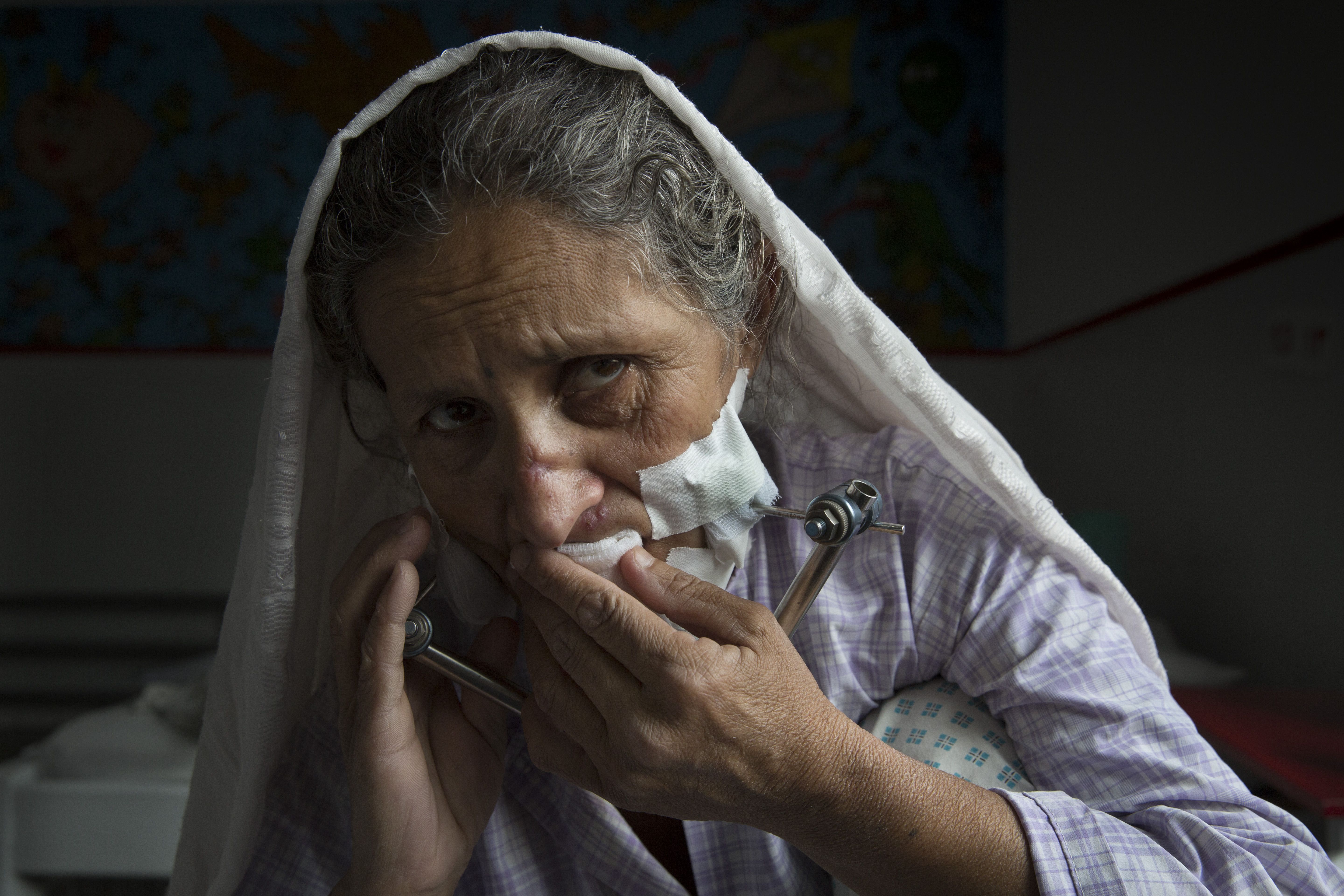 Aman Gull received a painful bullet wound to her face during a fight between police and Taliban members. Image by Paula Bronstein. Afghanistan, 2015. 