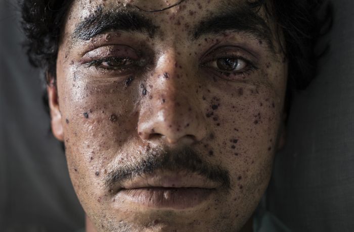 Kharim Ahmad, 22, suffered shrapnel wounds on his face and the loss of a leg from fighting in Sangin.
