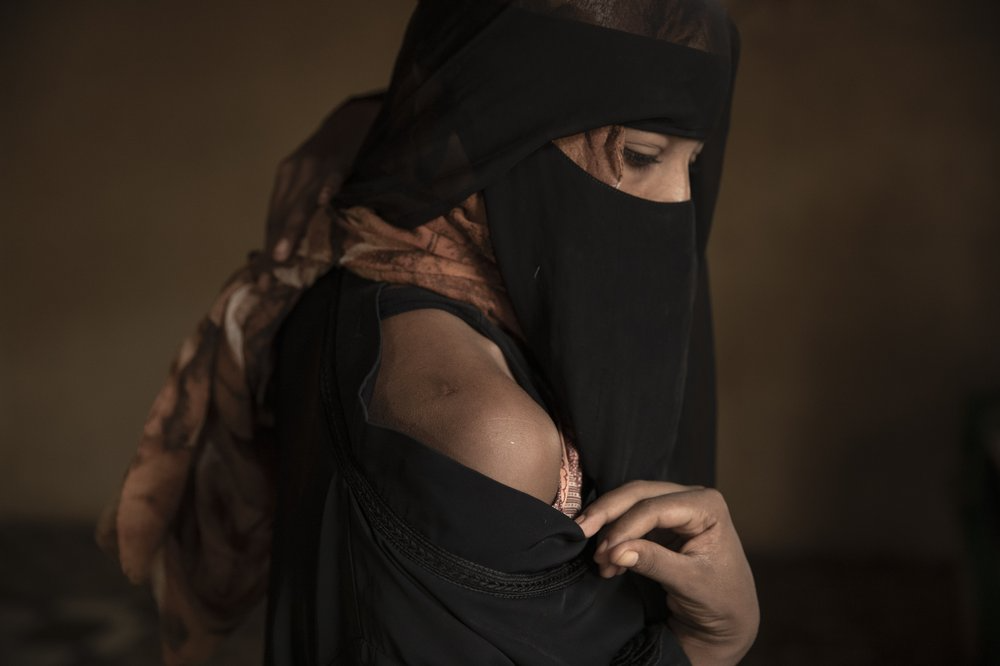 Ethiopian migrant Eman Idrees shows her shoulder with a wound from torture after being held and abused for eight months in a desert compound known in Arabic as a "hosh," run by an Ethiopian smuggler in Ras al-Ara. Image by Nariman El-Mofty. Yemen, 2019.