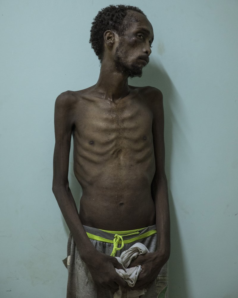 Ethiopian migrant Abdo Yassin, 23, of Oromo descent, stands for a photo at the Ras Alara Hospital, in Lahj, Yemen. Yassin says he was in a hosh locked up and tortured for months because he didn't have the money to pay a ransom. Image by Nariman El-Mofty. Yemen, 2019.