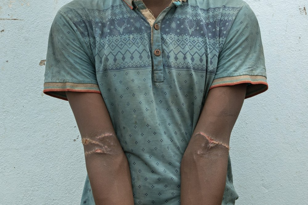 Ehiopian migrant Ibrahim Bakalah Hassan, 24, shows scars from torture in a hosh in Lahj, Yemen. He says his arms were tied behind his back, and wants to go back to Ethiopia. Image by Nariman El-Mofty. Yemen, 2019.