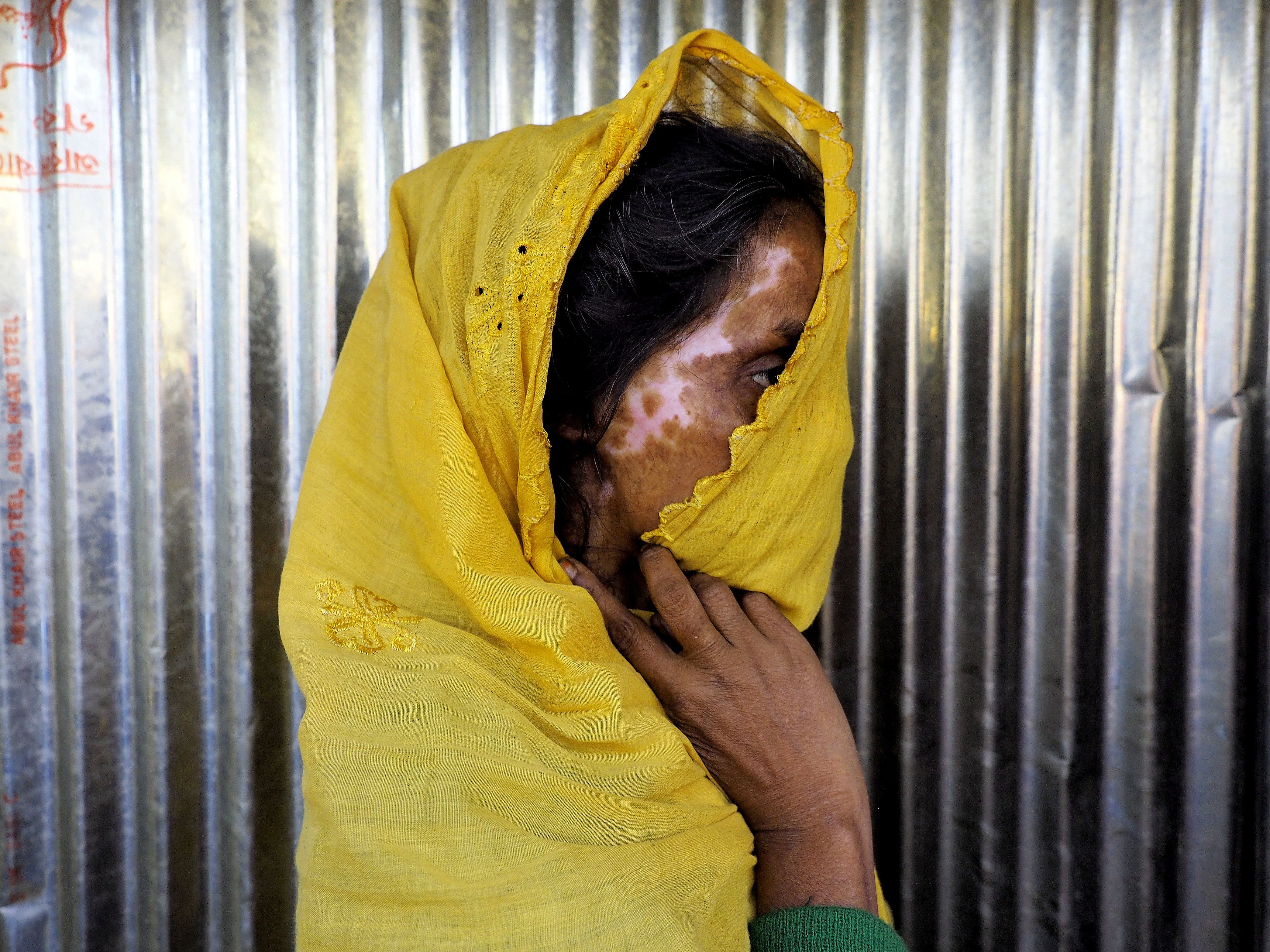 A Rohingya refugee displays her burn scars. Image by Doug Bock Clark. Bangladesh, 2017.