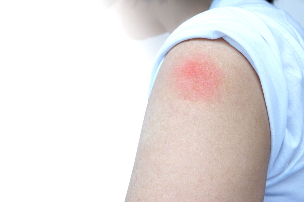 Skin rash and swelling on a woman's arm cause by a rabies vaccine. Image by Mitch Saint / Shutterstock.