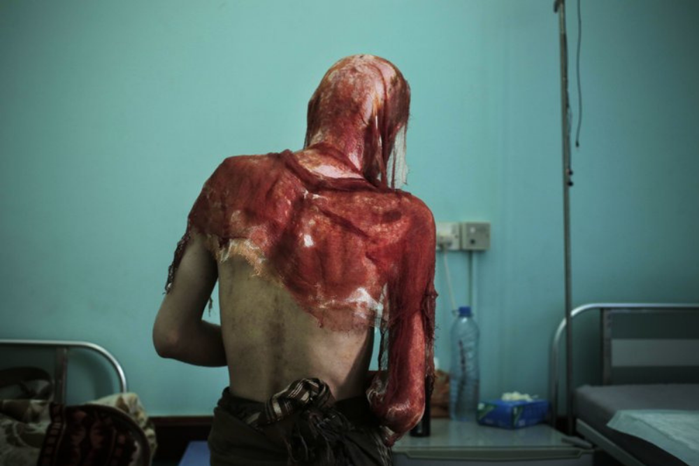 Monir al-Sharqi walks to his bed after nurses changed the dressings on his burns, at the Marib General Hospital.  Image by Nariman El-Mofty for AP News. Yemen, 2018.