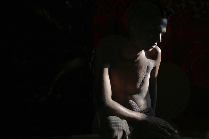 In this Friday Nov. 24, 2017, photo, Mohammadul Hassan, 18, is photographed in his family’s tent in Jamtoli refugee camp in Bangladesh. Hassan still bears the scars on his chest and back from being shot by soldiers who attempted to kill him. More than 650,000 Rohingya Muslims have fled to Bangladesh from Myanmar since August, and many have brought with them stories of atrocities committed by security forces in Myanmar, including an Aug. 27 army massacre that reportedly took place in the village of Maung Nu. Image by Wong Maye-E. Bangladesh, 2017.