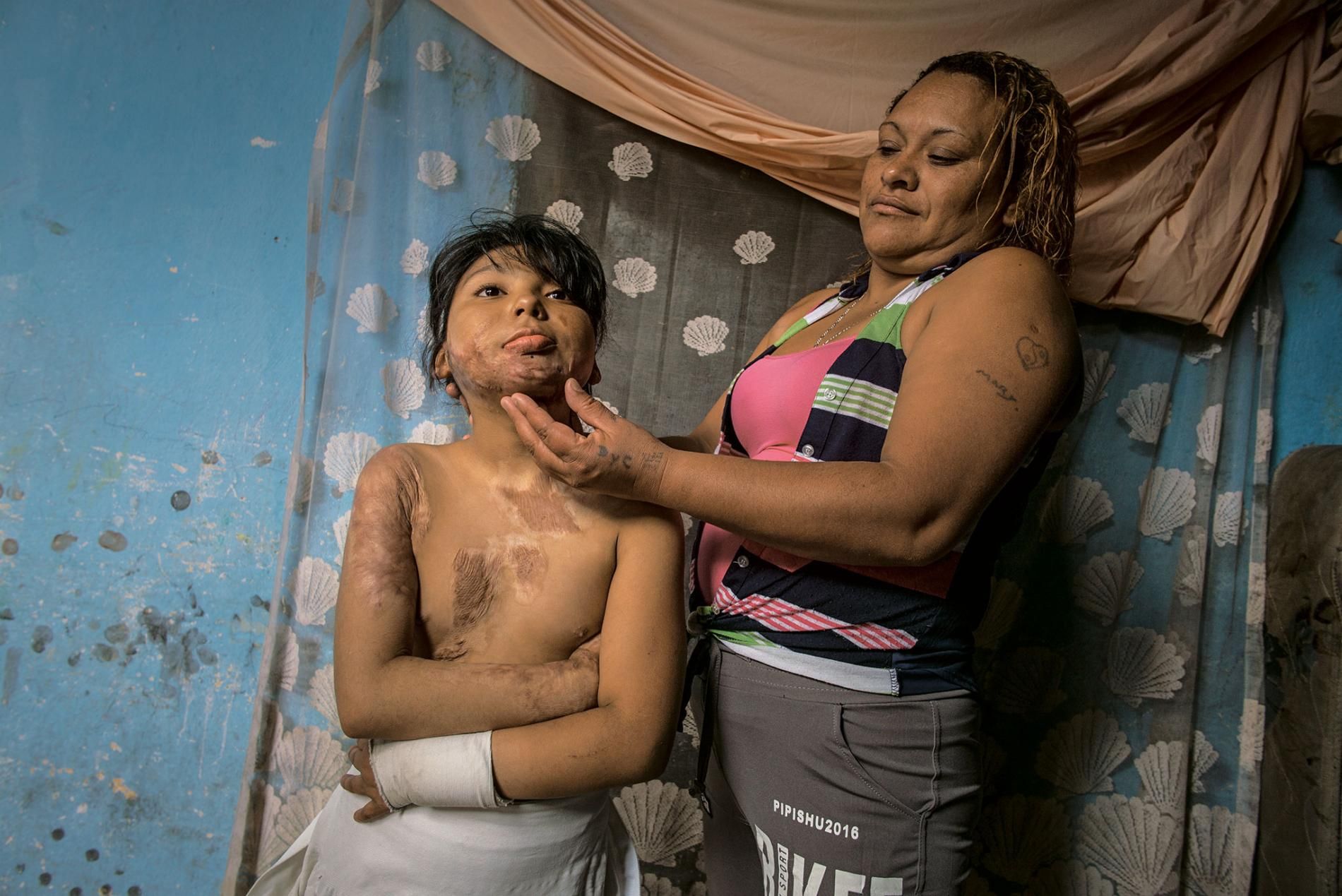 Two years ago Kimberly Galindo was severely burned by her family's open cooking fire. Now 10, she is still undergoing cosmetic surgery for the scars, as well as physical therapy. Image by Lynn Johnson. Guatemala, 2017.