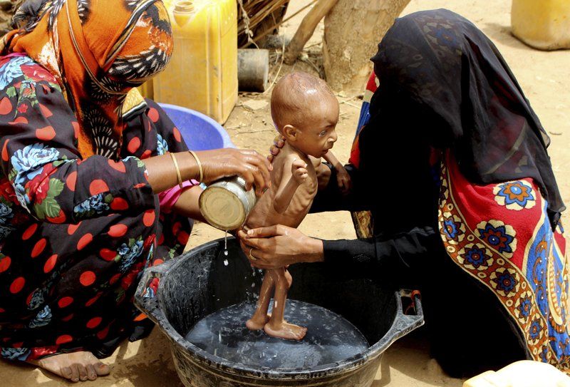 A severely malnourished infant is bathed in a bucket in Aslam, Hajjah.  Image by Hammadi Issa/AP Photo. Yemen, 2018.