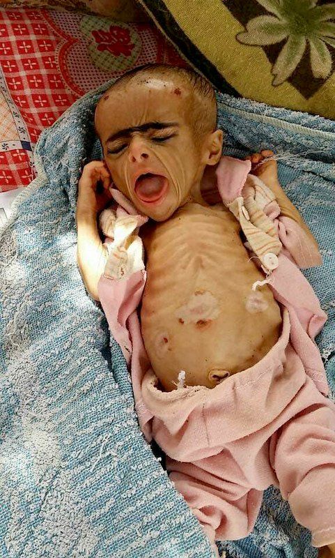 A severely malnourished infant at the Aslam Health Center. Image by Dr. Mekkiya Mahdi via AP. Yemen, 2018.