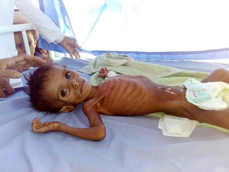 A severely malnourished child at the Aslam Health Center. Image by Dr. Mekkiya Mahdi via AP. Yemen, 2018.