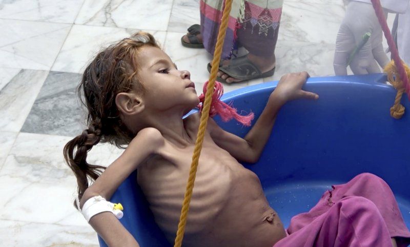 A severely malnourished girl is weighed at the Aslam Health Center. Image by Hammadi Issa/AP Photo. Yemen, 2018.