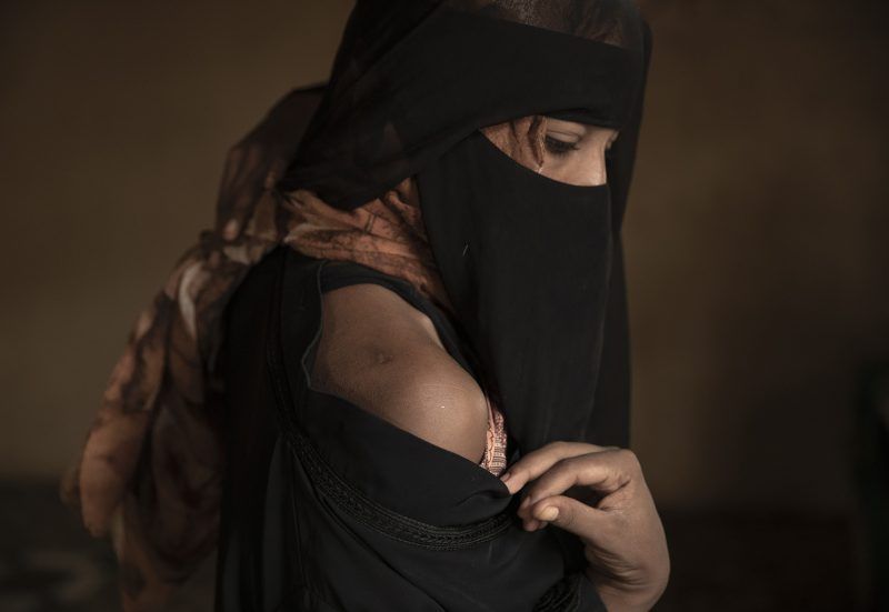 Ethiopian migrant Eman Idrees shows her shoulder, July 21, 2019, with a wound from torture after being held and abused for eight months in a desert compound, known in Arabic as a "hosh," run by an Ethiopian smuggler in Ras al-Ara, Lahj, Yemen. Image by AP Photo / Nariman El-Mofty. Yemen, 2019.