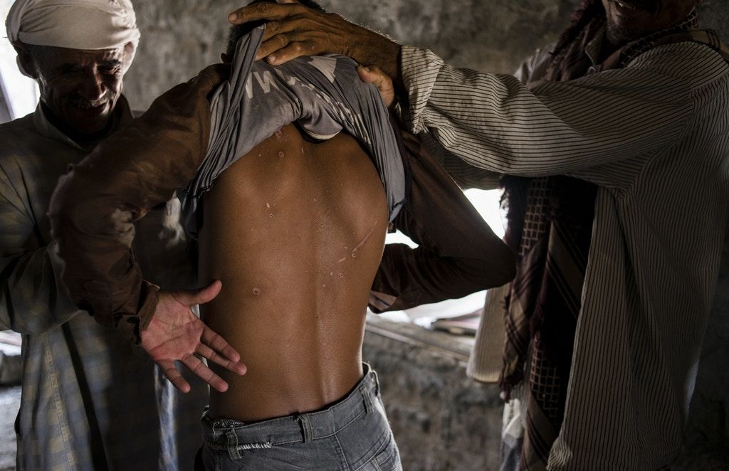 Yemeni men show the scars from fragmentation injuries on a young man from the village. Image by Alex Potter. Yemen, 2018.