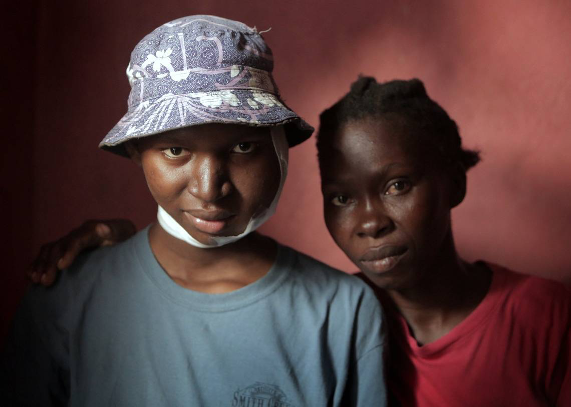 Angena Altidor went to at least five different doctors and dentists to find out why her 17-year-old son, Djooly Jeune, was growing a tumor on his face. She finally got her answer earlier this year: Burkitt’s lymphoma. Image by José A. Iglesias. Haiti, 2018.