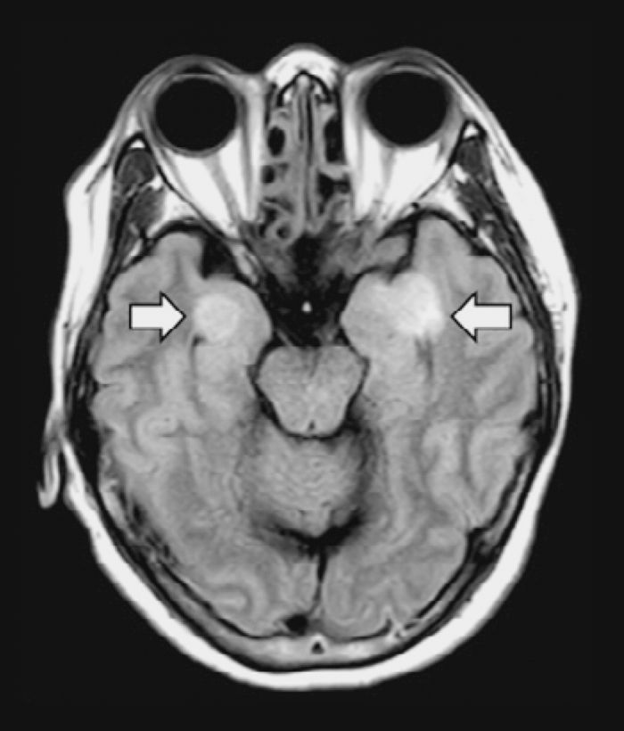 A 58-year-old woman with COVID-19 developed encephalitis, resulting in tissue damage in the brain (arrows). N. Poyiadji et al., Radiology, (2020). doi.org/10.1148/radiol.2020201187
