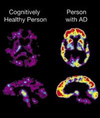 PET brain scans that track the progression of Alzheimer's Disease. Pittsburgh Compound B (PiB) binds to beta-amyloid plaques in the brain and can be imaged using PET scans. Initial studies showed that people with Alzheimer's Disease take up more PiB in their brains than do cognitively healthy older people. 