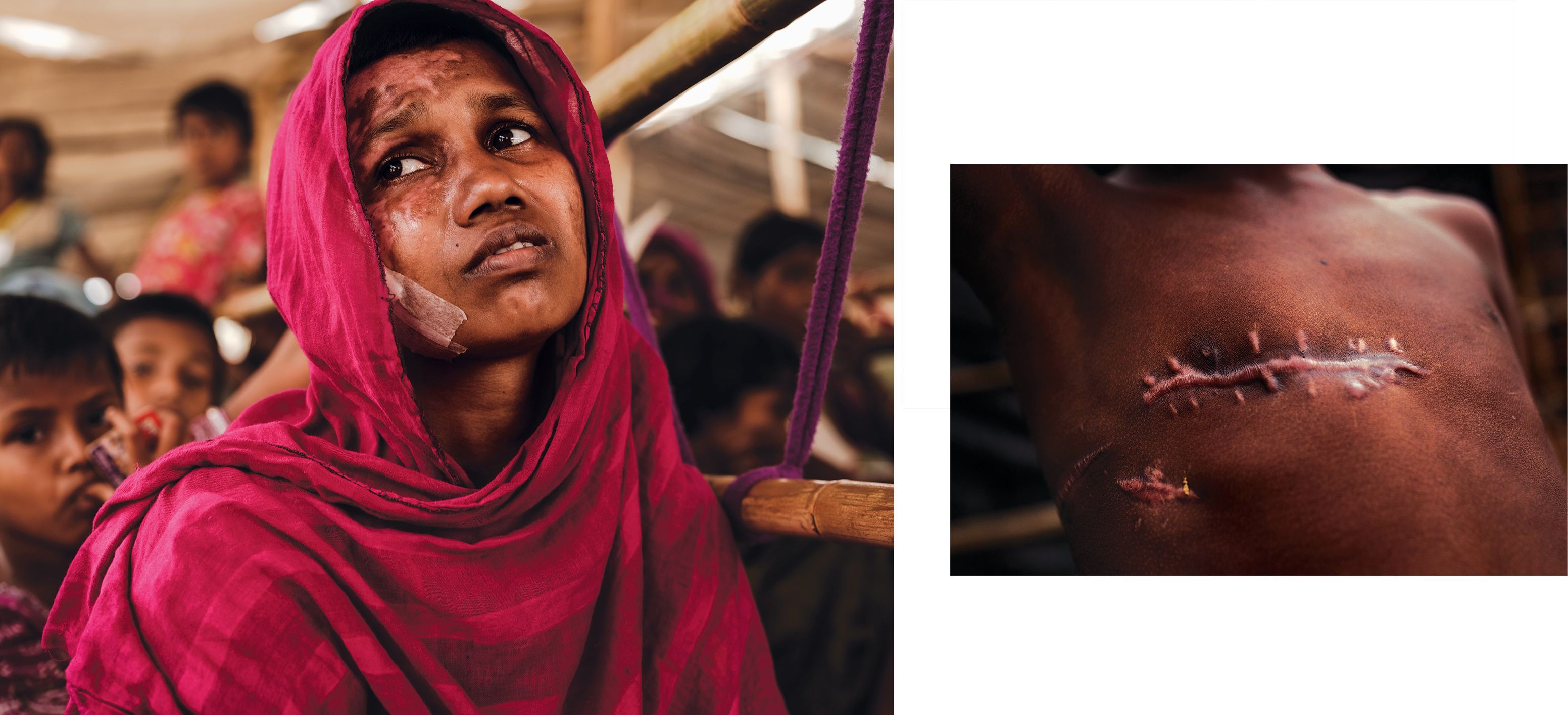 The physical evidence of atrocities is overwhelming among survivors in the refugee camps. Momtaz Begum (left) was treated for burns to her face and body. Seven year old Mohammad Shohail was shot in the chest. Image by Patrick Brown/Panos Pictures/UNICEF. Bangladesh, 2017.