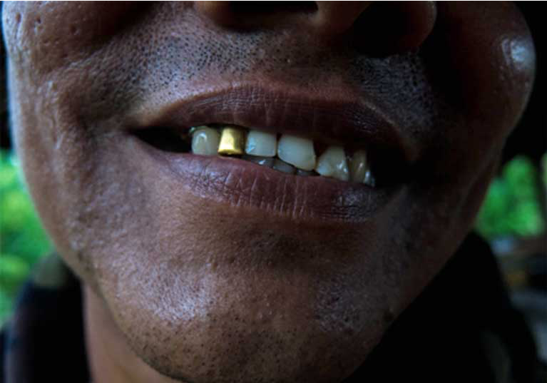 Manuel Álvarez (not his real name) shows off his golden tooth. He mined the gold himself. Image by by Bram Ebus. Venezuela, 2017.