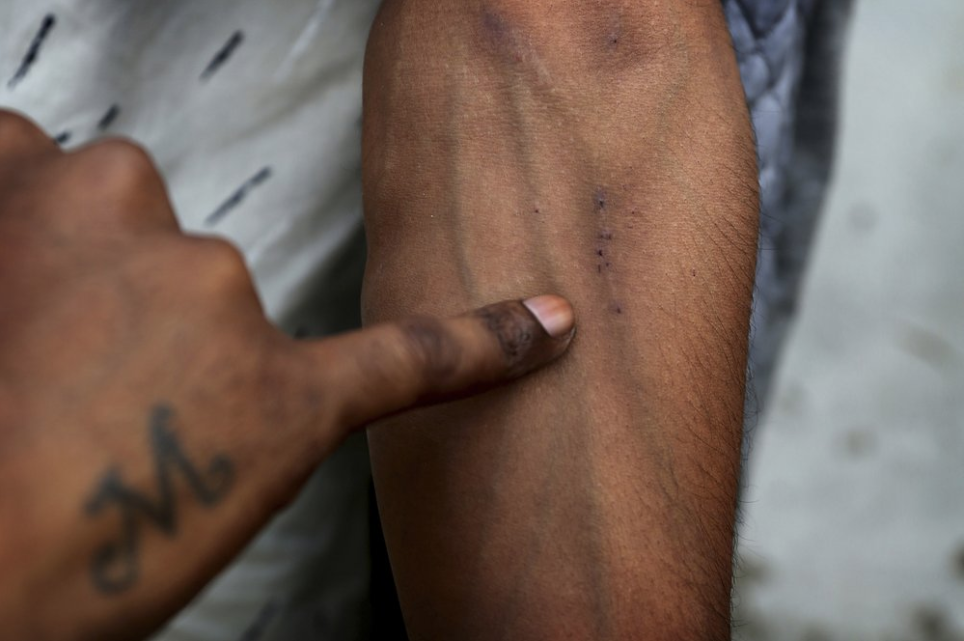 In this Thursday, Oct. 31, 2019, photo, a recovering drug user shows his veins at a de-addiction center in Kapurthala, in the northern Indian state of Punjab. India has twice the global average of illicit opiate consumption. Researchers estimate about 4 million Indians use heroin or other opioids, and a quarter of them live in the Punjab, India's agricultural heartland bordering Pakistan. The country scheduled tramadol in April 2018. But regulators acknowledge that the vastness of the pharmaceutical industry and the ingenuity of traffickers makes curtailing abuse and illegal exports all but impossible. Tramadol is still easy to find. Image by Channi Anand / AP Photo. India, 2019.