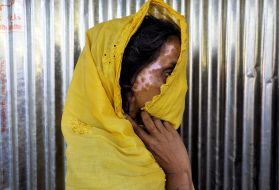 A Rohingya refugee displays her burn scars. Image by Doug Bock Clark. Bangladesh, 2017.